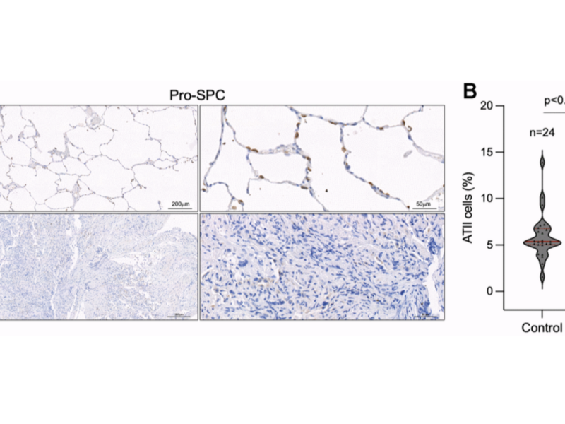 Figure 5. Decreased number of alveolar type II cells in the lungs of COVID-19 patients.