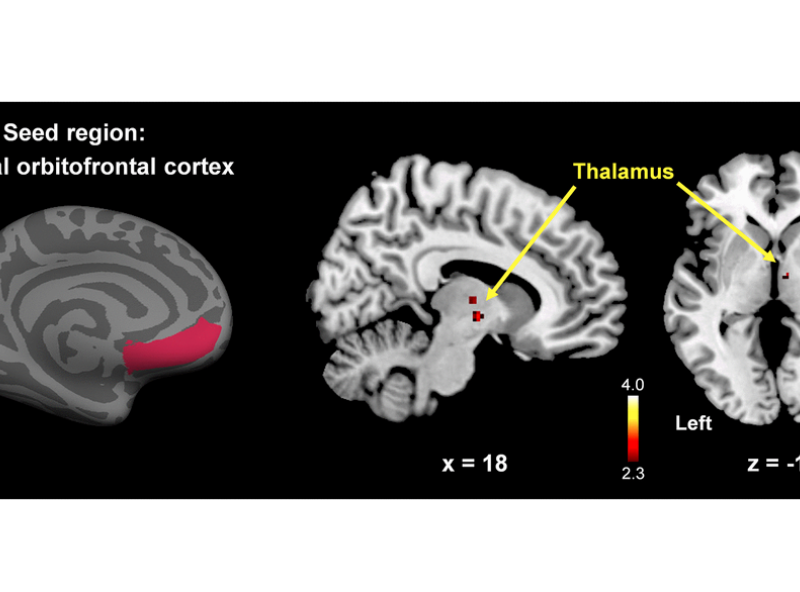 Figure 6. Between-group comparison map (premenopausal women vs. postmenopausal women) of the left mOFC functional connectivity.